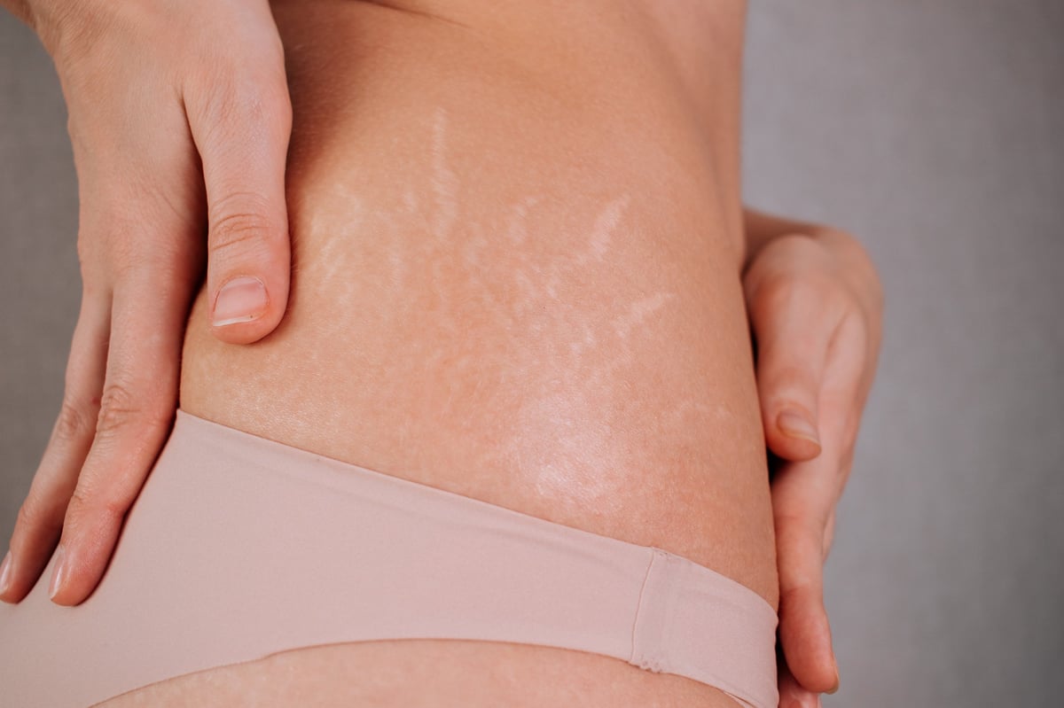 Close view of skin texture representing stretch mark camouflage treatment