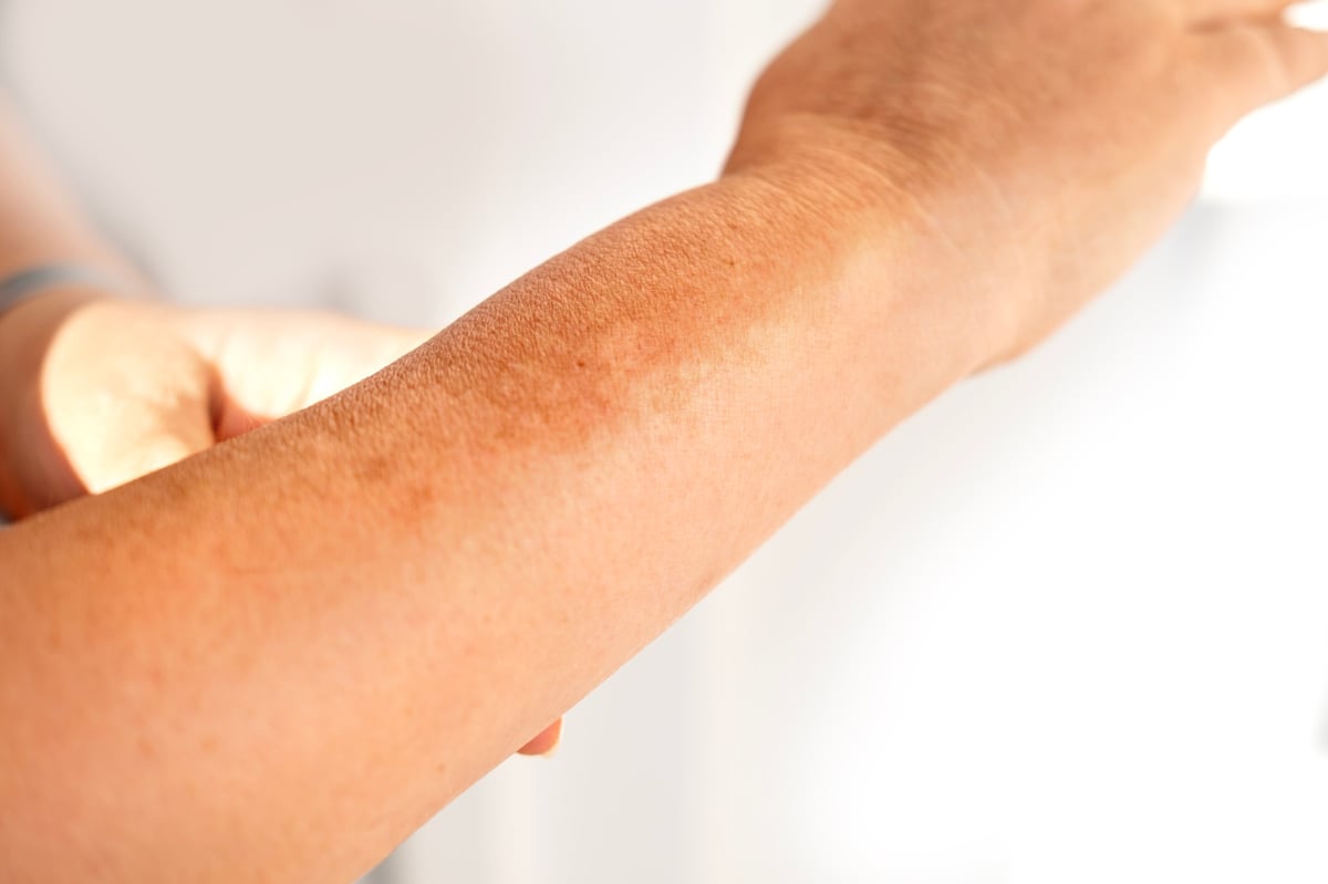 Close-up of skin with pigmentation, representing skin tone correction treatment